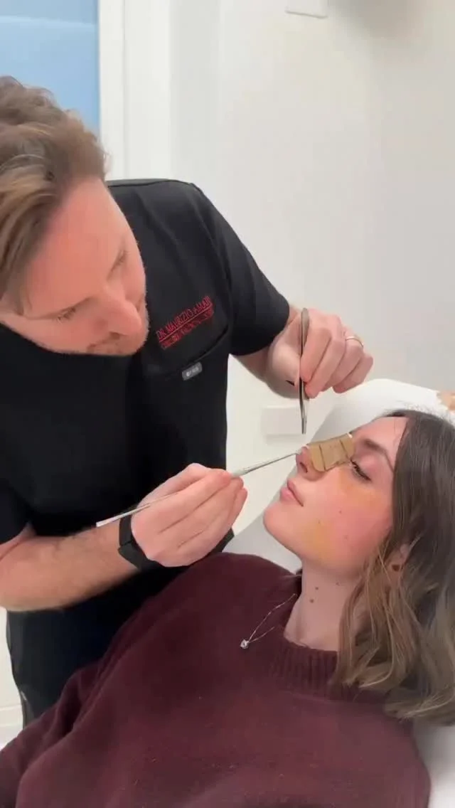 La rimozione del gessetto rappresenta sempre un momento significativo nel percorso post-operatorio.
La felicità delle mie pazienti confermano il valore del lavoro svolto e l’attenzione dedicata ad ogni dettaglio. ❤️

📞 +39 392 1383817
📍Amato Medical Institute - Via Fiorelli 12, Napoli
📬 info@maurizioamato.com
🌍 www.maurizioamato.com

#rinoplastica #rinosettoplastica
#chirurgiaplastica #chirurgoplasticonapoli #chirurgianapoli