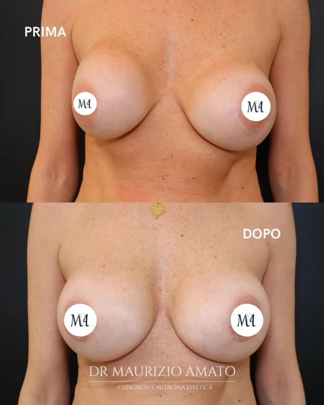 Una situazione complessa, sia dal punto di vista funzionale che estetico.

Questa paziente presentava una contrattura capsulare bilaterale di IV grado, con dolore, rigidità e una marcata distorsione del profilo mammario.
Un esito non soddisfacente fin dall’intervento eseguito 13 anni fa, progressivamente peggiorato nel tempo.

L’intervento di revisione è stato pianificato in modo preciso e mirato:

• accesso dalle cicatrici periareolari preesistenti
• capsulotomia completa bilaterale
• invio delle capsule a valutazione istologica
• sostituzione protesica con impianti ergonomici 500 cc alto profilo

L’obiettivo non era solo correggere una complicanza, ma ripristinare equilibrio, morbidezza e naturalezza.

Il risultato mostra un seno nuovamente armonico, con una forma più corretta e proporzionata, ma soprattutto senza dolore.

La chirurgia di revisione richiede esperienza, pianificazione e rispetto dei tessuti: ogni caso è unico e va trattato come tale.

📞 +39 392 1383817
📍Amato Medical Institute - Via Fiorelli 12, Napoli
📬 info@maurizioamato.com
🌍 www.maurizioamato.com

#contratturacapsulare #mastoplastica #interventoseno #chirurgoplasticonapoli #chirurgiaplastica