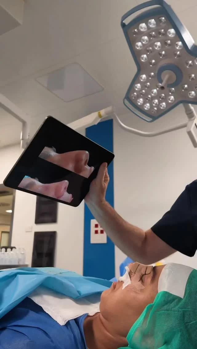 Un trauma a 10 anni. Un setto deviato verso sinistra. Anni di difficoltà respiratorie.

Questa è la rinosettoplastica di Manu, e nel video vi mostro il pre-intervento e il risultato subito a fine intervento, ancora sul tavolo operatorio.

Cosa abbiamo fatto:

▪️Asportata la porzione deviata del naso e ricostruita la parte caudale, dando una struttura totalmente nuova
▪️Regolarizzato il dorso e rettilinizzato il profilo, prima deviato a sinistra
▪️Lieve risollevamento della punta e rimodellamento complessivo

E due dettagli che fanno la differenza per il paziente:

✅Intervento eseguito in anestesia locale - niente anestesia
generale
✅Senza tamponi nasali: nessun fastidio della rimozione,
respirazione libera fin da subito

Il risultato è una nuova armonia del viso - ma soprattutto un naso che respira. Perché la rinosettoplastica non è solo estetica: è funzione ed estetica insieme, nello stesso intervento.

Casi come questo, esiti di un trauma, richiedono tecniche specifiche e una pianificazione precisa. Ne è valsa la pena. 👃

Ci rivediamo ai controlli, Manu. 🙏🏻

📞 +39 392 1383817
📍Amato Medical Institute - Via Fiorelli 12, Napoli
📬 info@maurizioamato.com
🌍 www.maurizioamato.com

#chirurgoplastico #chirurgiaplastica #rinoplastica #rinosettoplastica #chirurgoplasticonapoli
