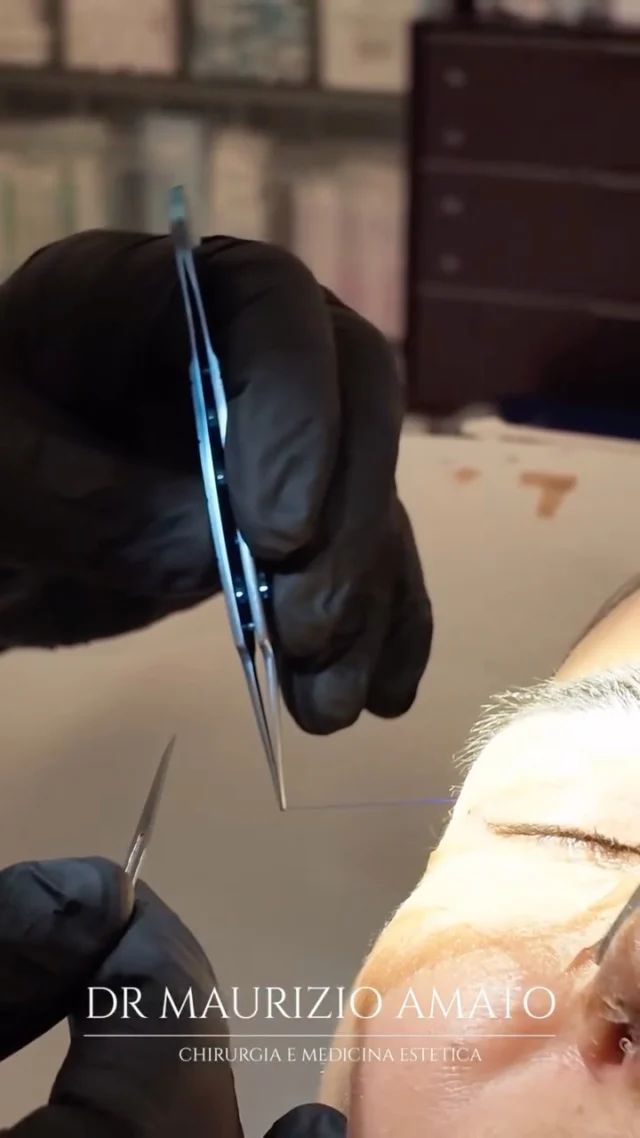 La rimozione dei punti segna un momento importante nel percorso dopo un intervento di Blefaroplastica superiore.

Un risultato naturale in cui è stato possibile ridonare al suo sguardo luce giovinezza e armonia. ✨

📞 +39 392 1383817
📍Amato Medical Institute - Via Fiorelli 12, Napoli
📬 info@maurizioamato.com
🌍 www.maurizioamato.com

#blefaro #blefaroplastica #chirurgoplasticonapoli #chirurgiaplastica #naturalresult