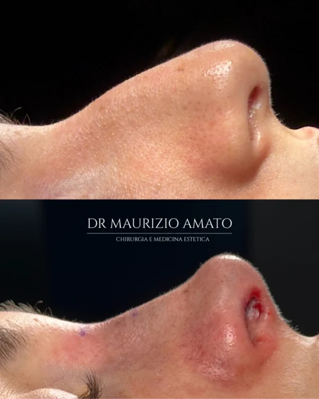 Rinosettoplastica in anestesia locale, senza tamponi, con dimissione in giornata.

Una delle domande che ricevo più spesso è: “dottore, quando vedrò il mio naso?”

In molti casi la risposta comincia già in sala operatoria. Queste immagini sono state scattate a fine intervento: profilo riarmonizzato, dorso ridotto, punta ridefinita, e nessun tampone da rimuovere nei giorni successivi.

Restano l’edema e i piccoli segni fisiologici delle prime ore, che si risolvono con il decorso. Il naso definitivo arriva nei mesi, ma la direzione è già leggibile subito.

Anestesia locale, day surgery, respirazione libera dal primo momento.

📞 +39 392 1383817
📍Amato Medical Institute - Via Fiorelli 12, Napoli
📬 info@maurizioamato.com
🌍 www.maurizioamato.com

#chirurgoplastico #rhinoplasthy #plasticsurgeryclinic #nosesurgery #naturalresults