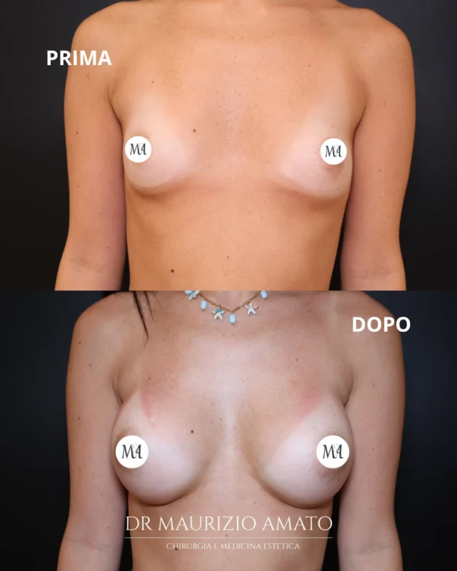 Un seno naturale, in armonia con il suo corpo. Proprio come lo desiderava Simona. ♥️

Si guardava allo specchio e sentiva che il suo seno non rispecchiava le proporzioni che desiderava.

Con la tecnica Preservé, ho valorizzato il volume e la forma del seno, con un approccio volto a preservare i tessuti mammari e rispettare la sua anatomia.

Il suo desiderio, la mia priorità: un risultato che sentisse davvero suo.

Vuoi sapere se sei la candidata ideale per la tecnica Preservè? 
Scrivici in DM

📞 +39 392 1383817
📍Amato Medical Institute - Via Fiorelli 12, Napoli
📬 info@maurizioamato.com
🌍 www.maurizioamato.com

#chirurgoplastico #chirurgiaplastica #mastoplasticapreservè #mastoplastica #chirurgoplasticonapoli